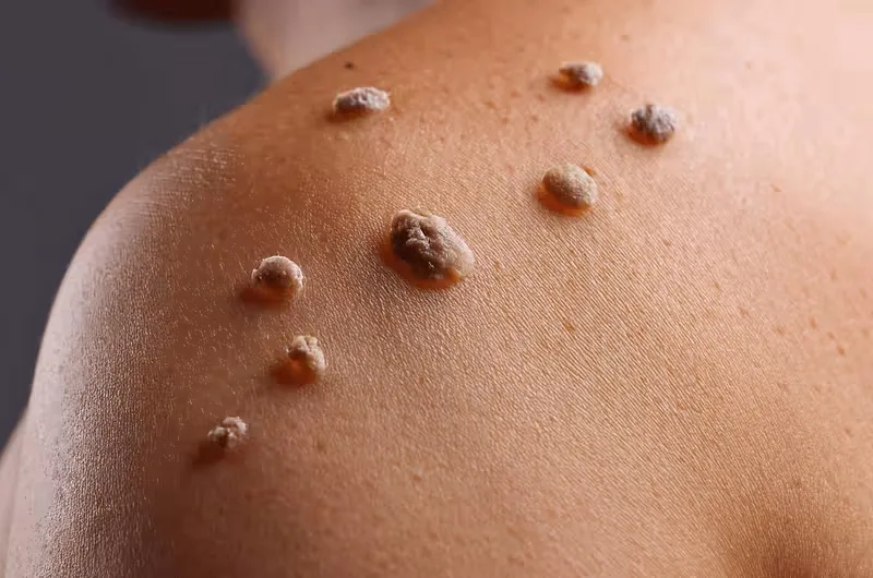 Warts Removal